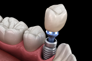 Crown and abutment being attached to dental implant in Edmonton, AB