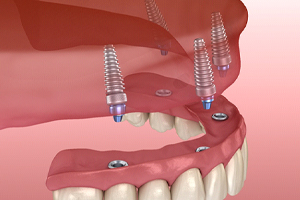 Denture about to be attached to four dental implants in Edmonton, AB