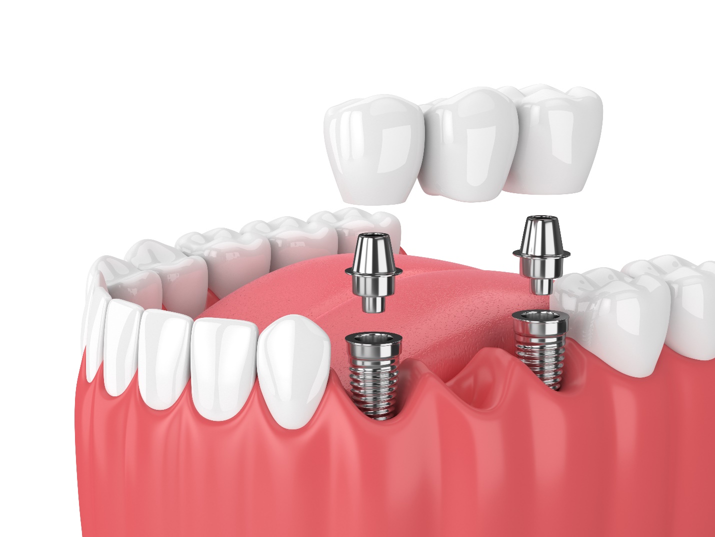 An implant bridge in West Edmonton