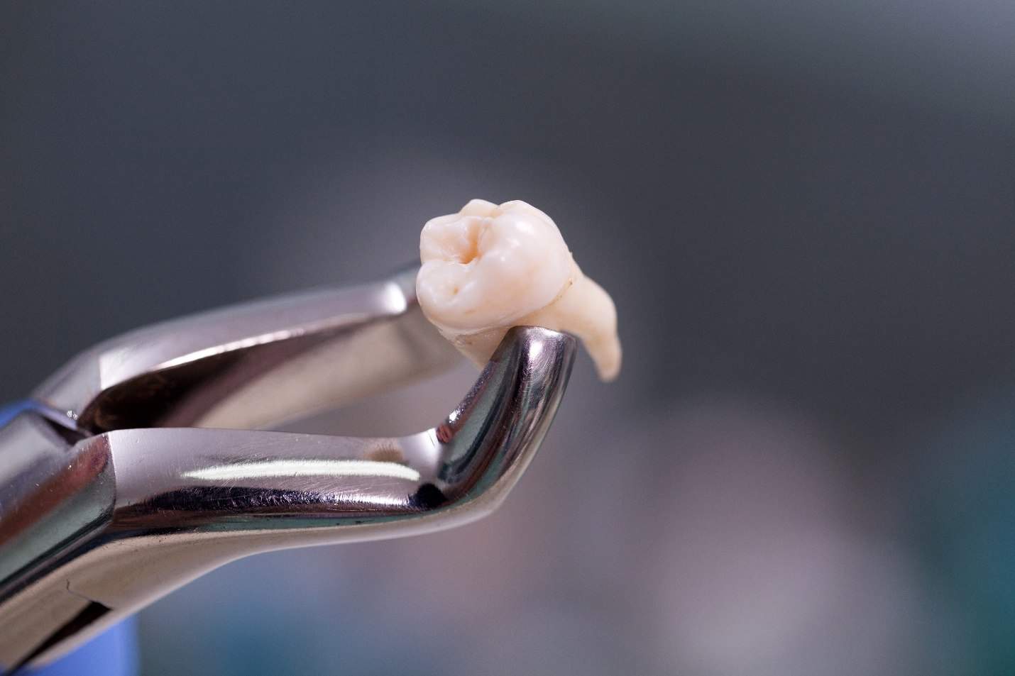 Close-up of tooth gripped in forceps following extraction