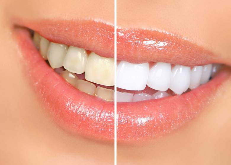 Closeup before and after of teeth whitening in Edmonton