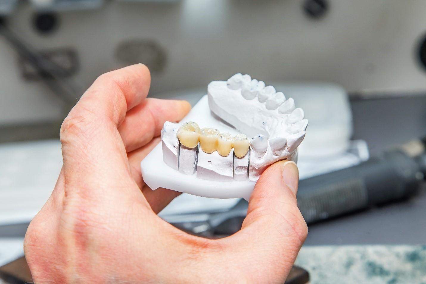 Dental bridge in Edmonton on clay mold