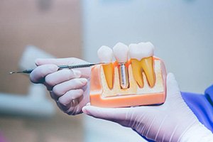 dentist demonstrating how dental implants work in Edmonton
