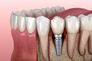 illustration of how dental implants work in Edmonton